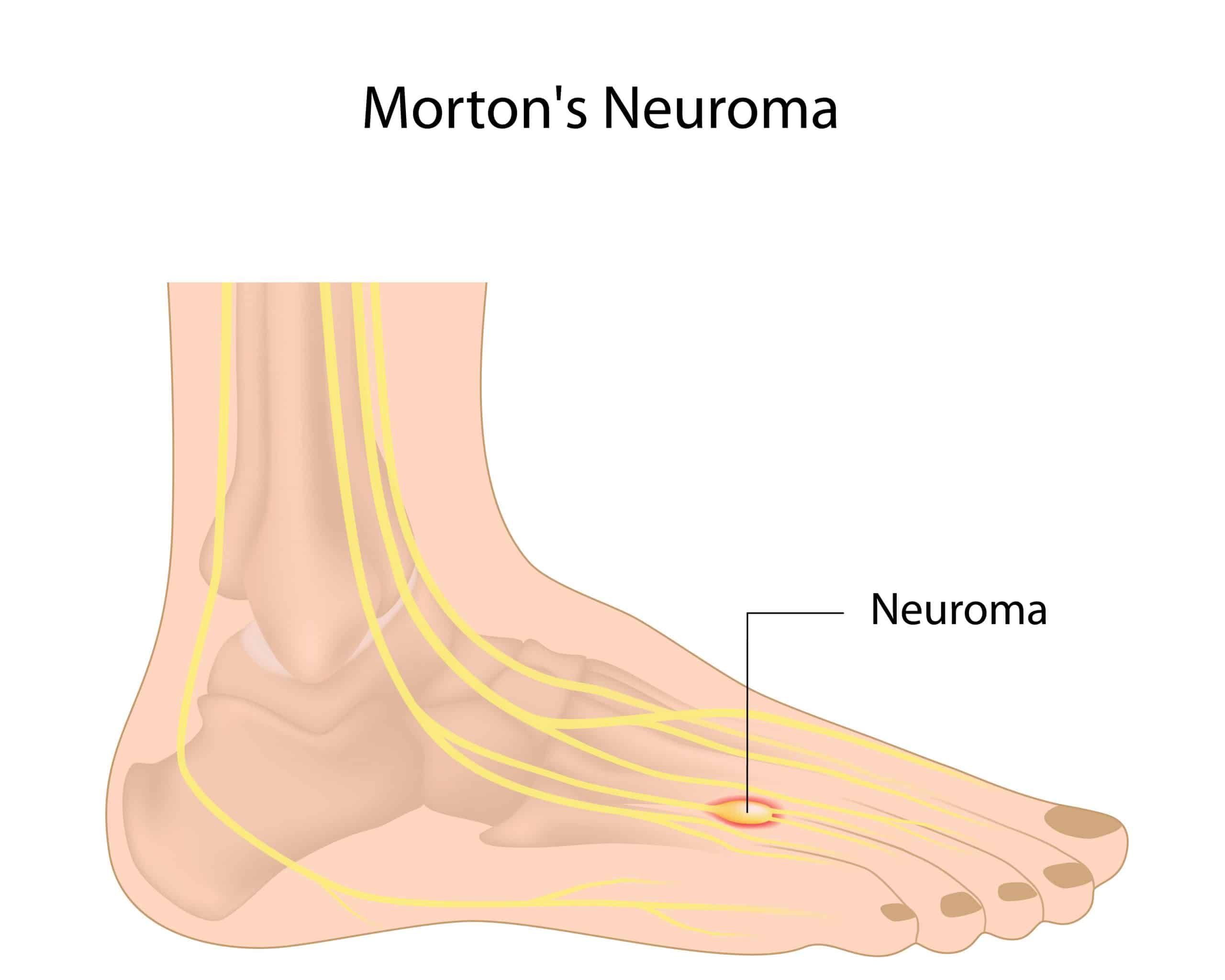 fda-fast-tracks-new-injection-for-morton-s-neuroma