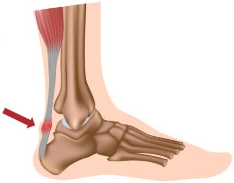 Achilles Tendinopathy & How To Fix It | The Foot Pod